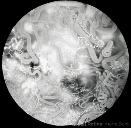 Ocular Manifestations of Wyburn-Mason Syndrome - EyeWiki