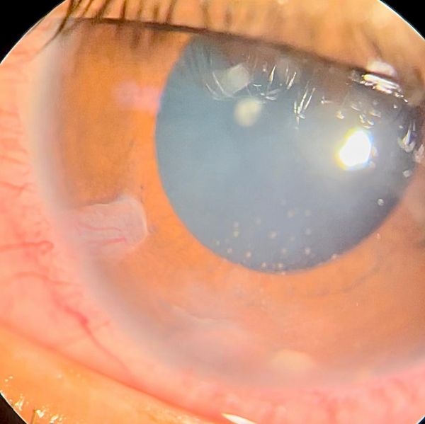 File:KPs close to AC granuloma.jpeg