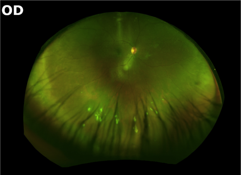 File:Snowballs uveitis.png