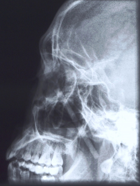 File:X Ray with FB.jpg