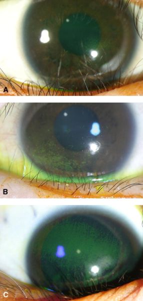 File:Keratopathy.jpg
