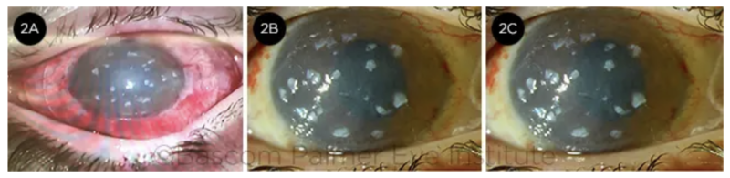 File:Simple Limbal Epithelial Transplant.png