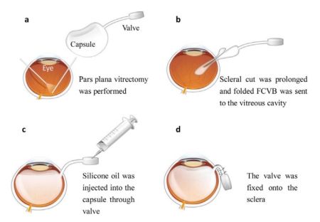 Foldable Capsular Vitreous Body - EyeWiki
