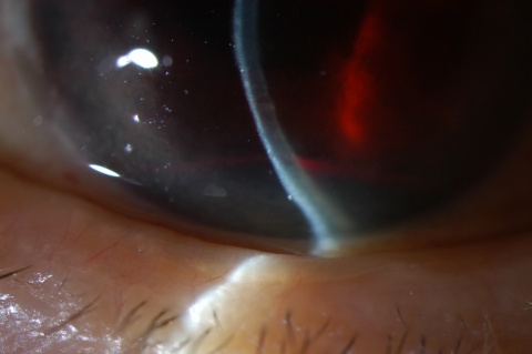 Figure 4. Slit-beam photo with hyphema visible within the inferior anterior chamber (same eye as Figure 3).