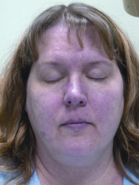 File:Rosacea.jpg