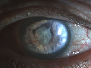 Figure 1: Advanced NVG with florid rubeosis iridis
