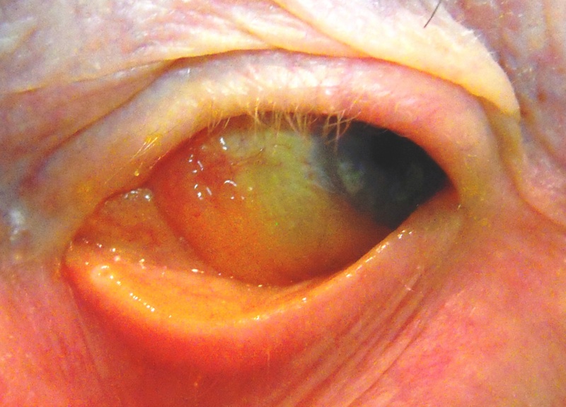 File:Conjunctival Amyloid.JPG