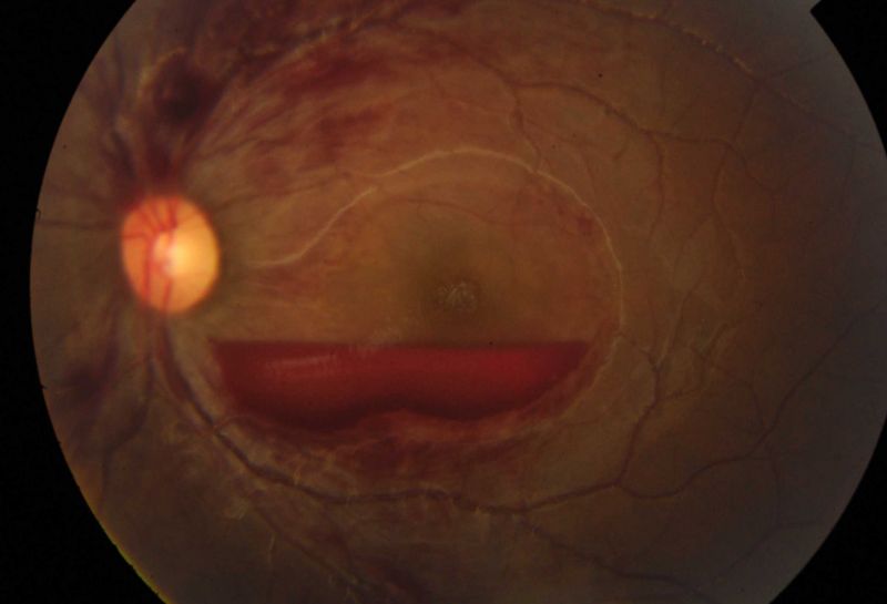 File:Figure 2 Subhyaloid Hemorrhage.jpg