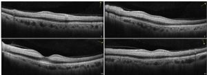 OCT showing placoid and hyperreflective bands at the INL level, sparing the outer retina.