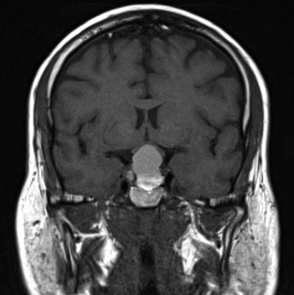 File:PituitaryAdenoma.JPG