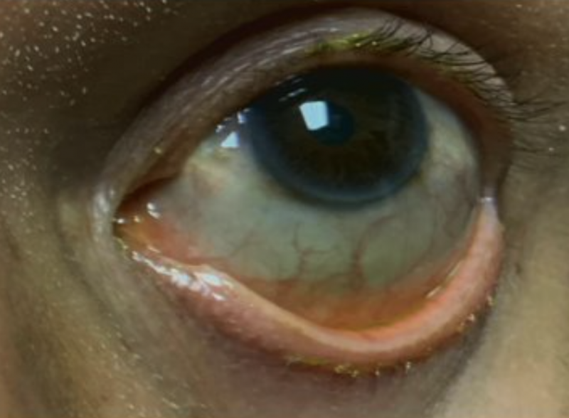 File:Blue sclera left eye.png