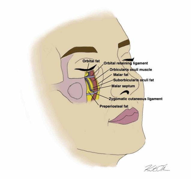 File:Figure 1 Prezygomatic Space.jpg