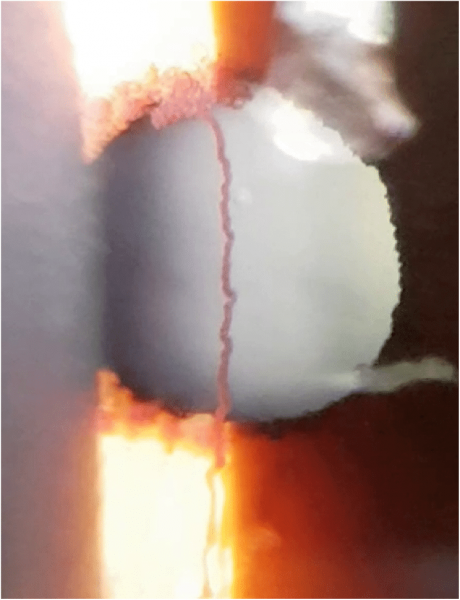 File:Active bleeding Iris Microhemangioma.png