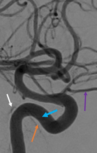 File:CCF Angio.jpg