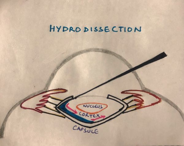 Hydro Manoeuvres in Cataract Surgery - EyeWiki