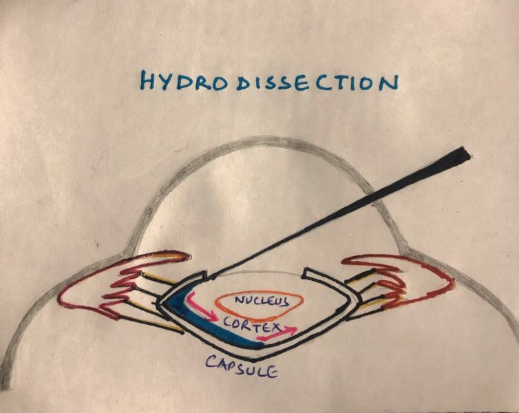 File:CORTICAL CLEAVING HYDRODISSECTION.jpeg