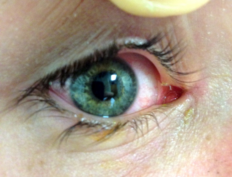 File:Cropped POW2 Canalicular Trauma.jpg