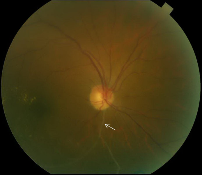 File:BRVO chronic.png