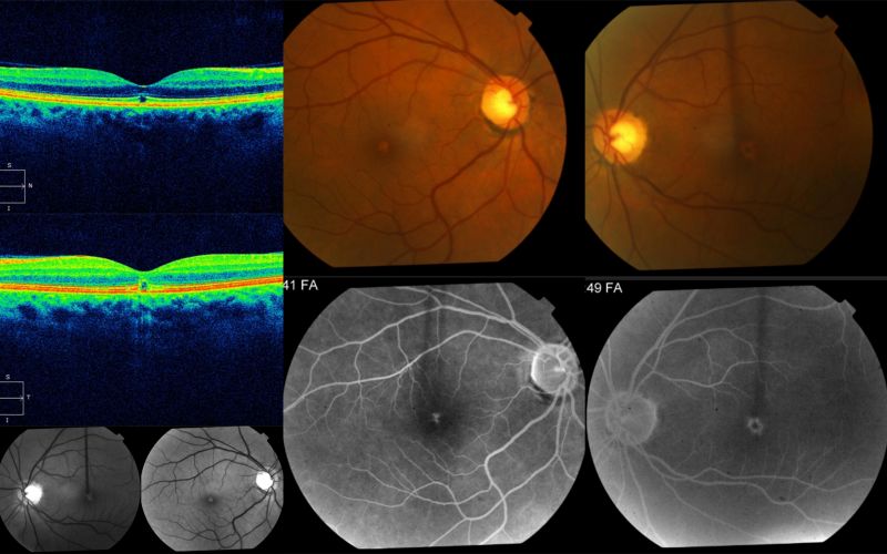 File:Established Solar retinopathy.jpg