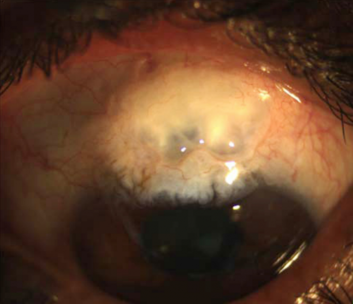 File:Glaucoma bleb.png