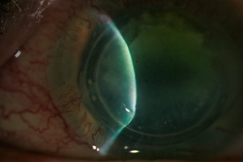 File:Infectious Keratitis.jpeg