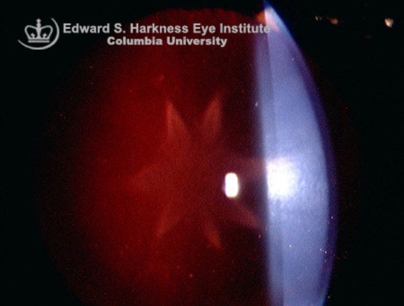 File:6 Rosette Cataract.png