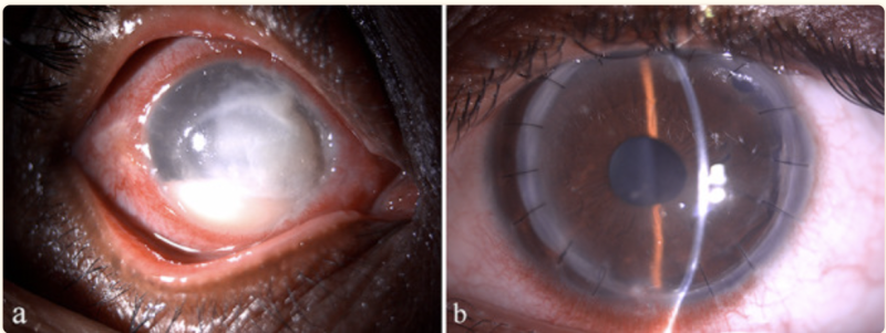 File:Figure 9 Eyewiki.png