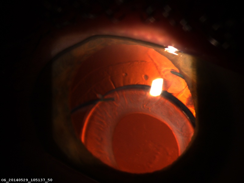 File:AAO Subluxed IOL.jpg