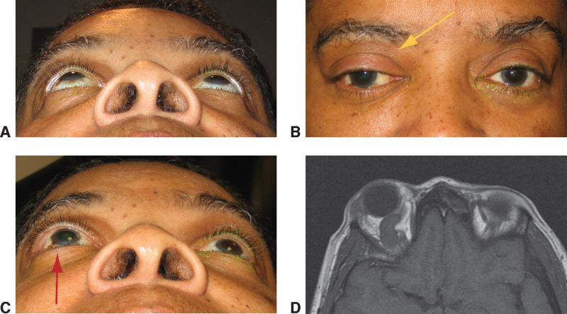 File:Distensible venous malformation.jpg