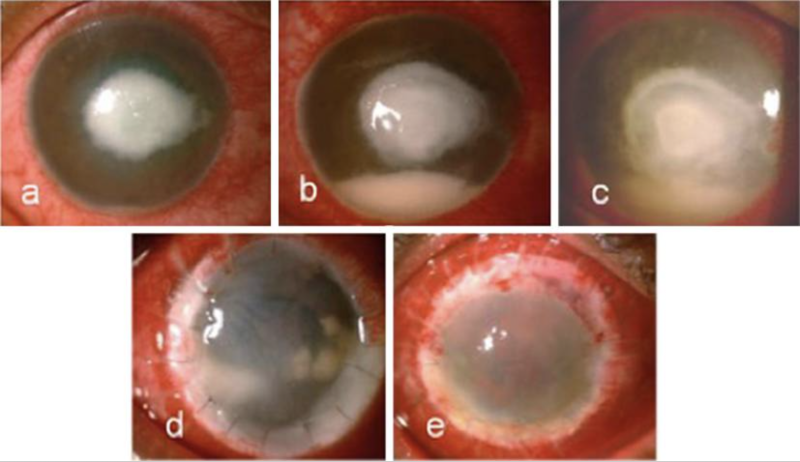 File:Figure 3 Eyewiki.png
