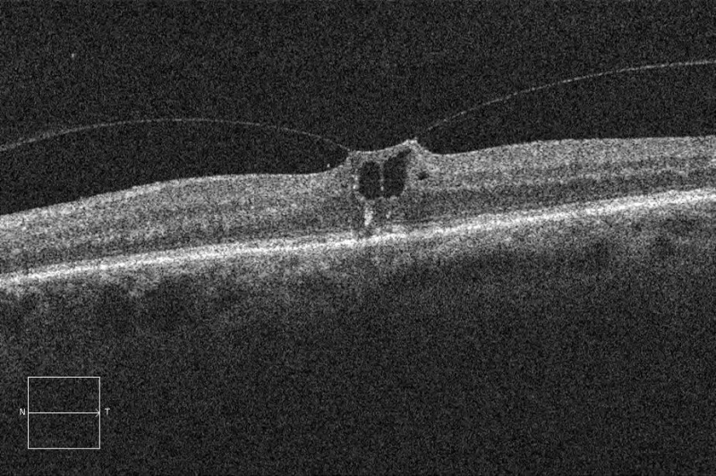 File:VMT OCT scan example 2.jpeg