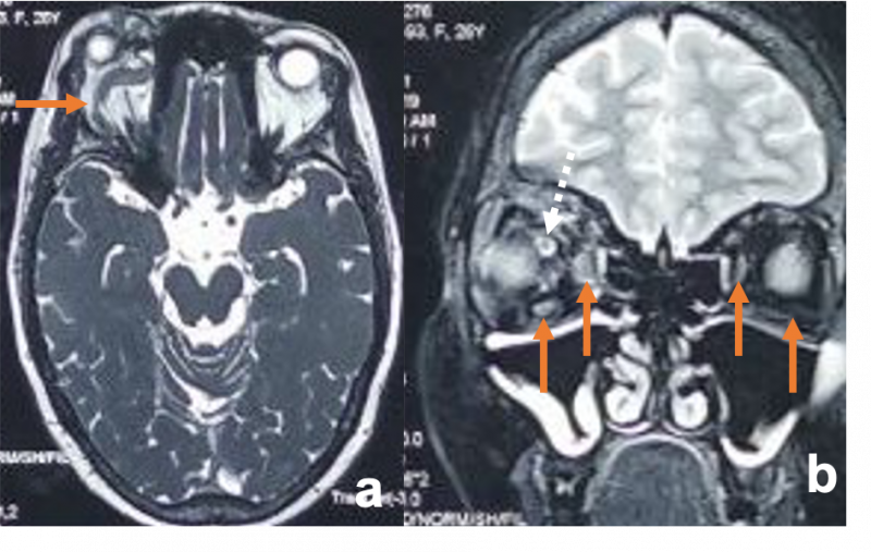File:Carotico-cavernous fistula.png