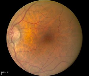 Color fundus photo of the left eye