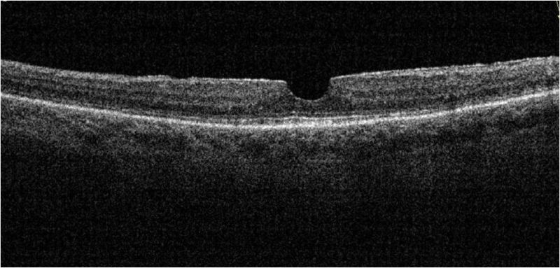 File:Pseudohole.jpg