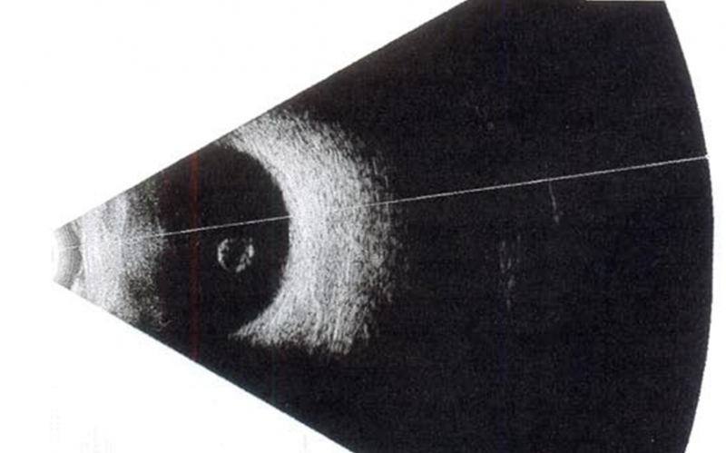 File:BscanofVitreousCyst.png