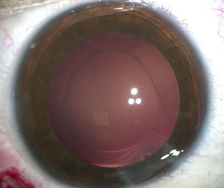 File:Stackable capsulorhexes.jpg