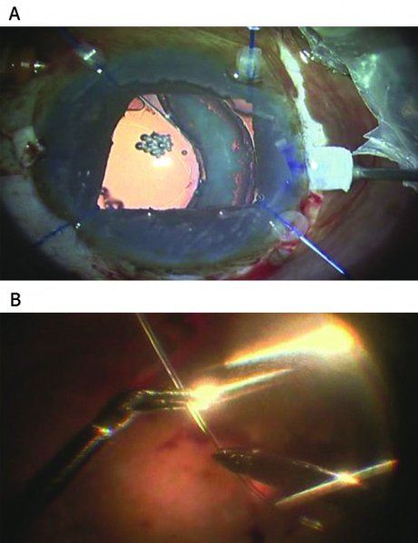 File:Subluxed4.jpg
