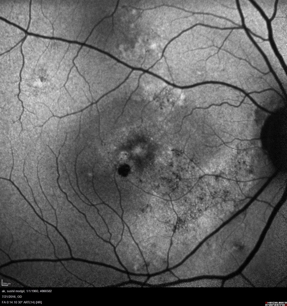 File:FAF chronic CSC.jpg