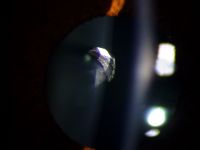 Intralenticular metallic foreign body (IOFB) has been reported in 10% to 41% of open globe injuries. Mechanism of injury is predictive of the presence of IOFBs. High-velocity, relatively small particles are the most common foreign bodies found in the eye. Hammering, grinding, or shaving metal, machine yard work such as lawn mowing, and explosives exposure are particularly high risk.