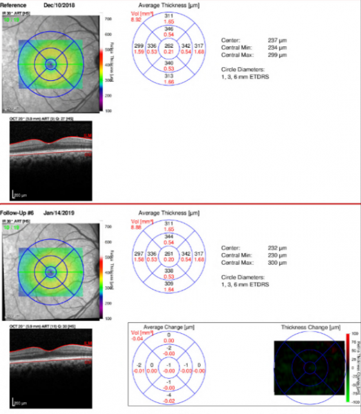 File:Spectralis 2 Thickness Map.PNG