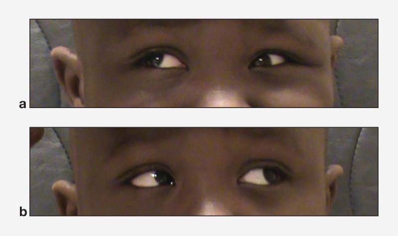 File:Brown syndrome.jpg