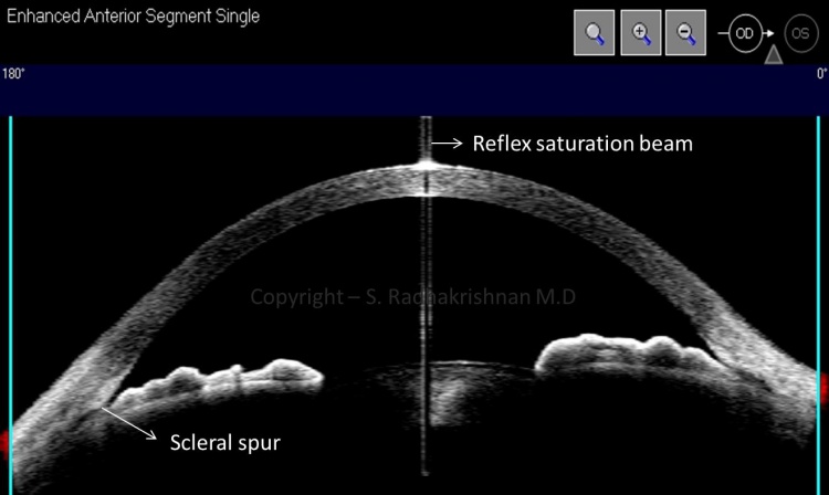 Anterior Segment Optical Coherence Tomography - EyeWiki