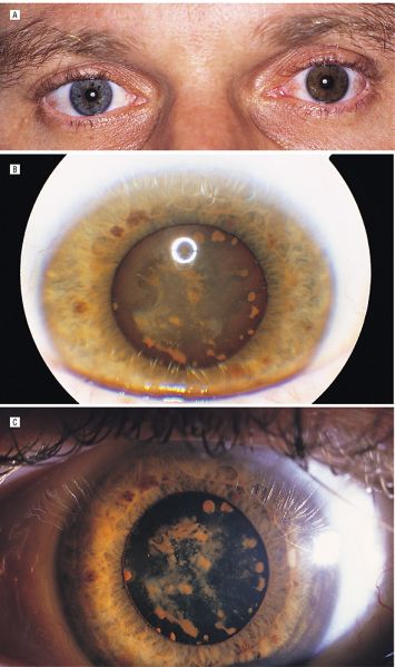 File:Siderosis, heterochromia, lens deposits.jpg