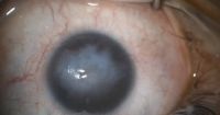 Pars Planar Tube Surgery for Aniridia-Associated Keratopathy