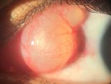 Figure 2B. Conjunctival inclusion cyst after blunt trauma. (Courtesy of Maria Emília Xavier dos Santos Araújo, PhD. Hospital of State Civil Servant, São Paulo [IAMSPE-SP].)