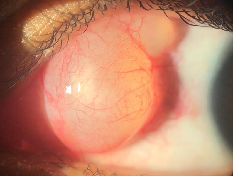 File:Conjuntival 2.jpg
