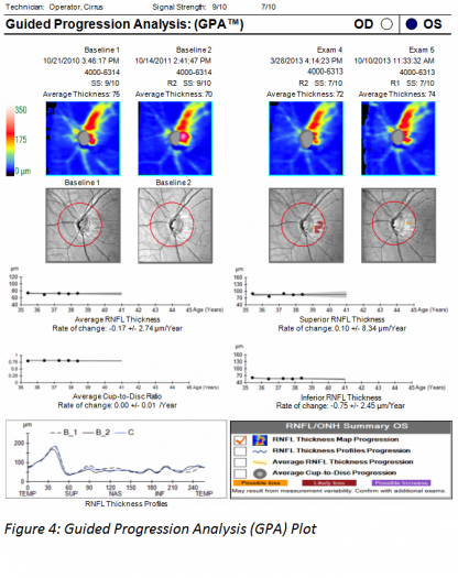 Spectral Domain Optical Coherence Tomography in Glaucoma - EyeWiki