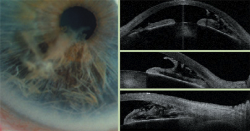 File:Iridoschisis OCT.png