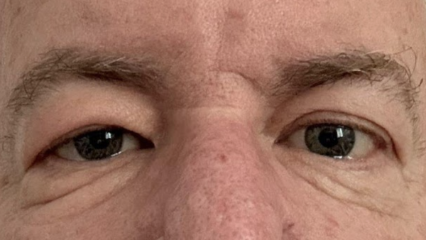 Morbihan Disease - EyeWiki