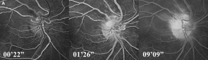 File:Neuroretinitis4.png